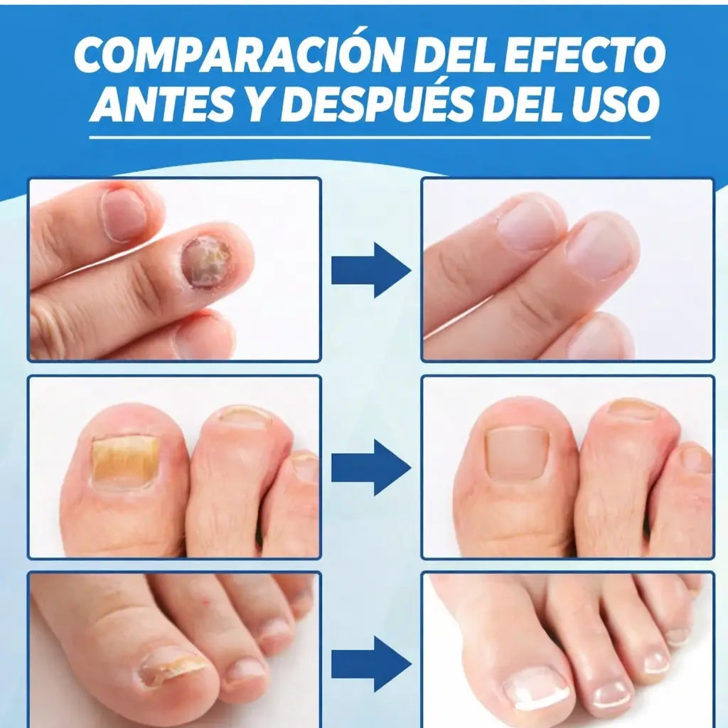 Láser Para Hongos de Uñas + 🎁 E-book gratis de cuidado