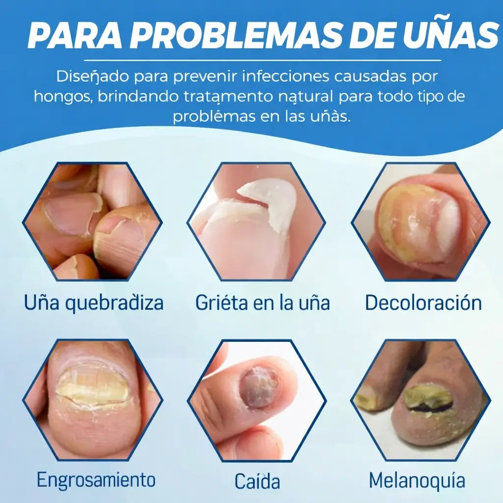 Láser Para Hongos de Uñas + 🎁 E-book gratis de cuidado