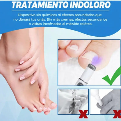 Láser Para Hongos de Uñas + 🎁 E-book gratis de cuidado